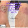 Propiderm cream 100ml