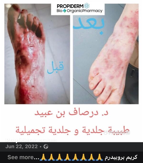 Propiderm cream 100ml