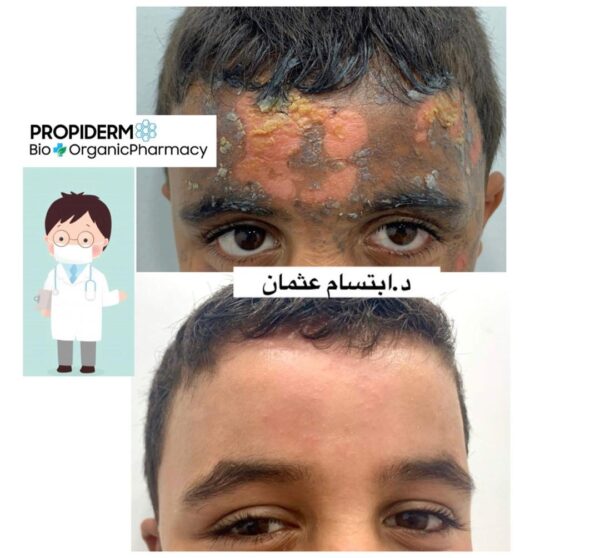 Propiderm cream 100ml